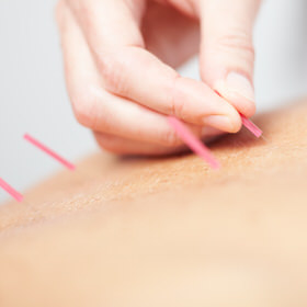 acupuncture back pain