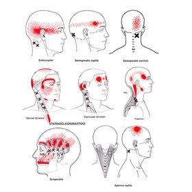Headaches and Trigger Point Therapy