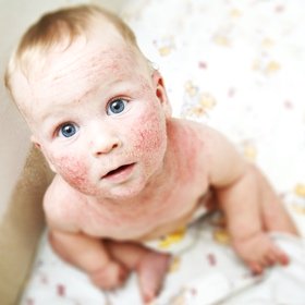 SH Health Baby eczema