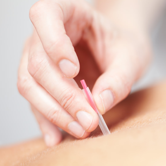 acupuncture needles