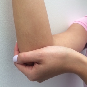 Tennis elbow and Golfer’s elbow