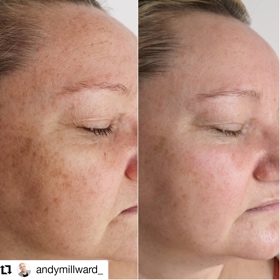 SH Health Flex MD Pigmentation