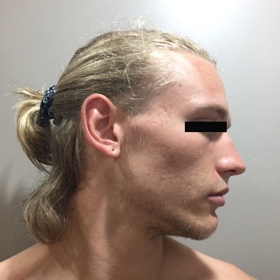 SH LED Acne after2