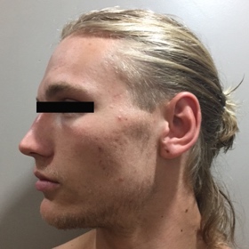 SH LED acne after