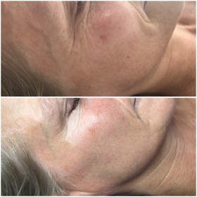 SH Tri Wave Rejuvenation