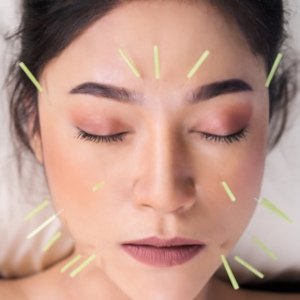 COSMETIC ACUPUNCTURE